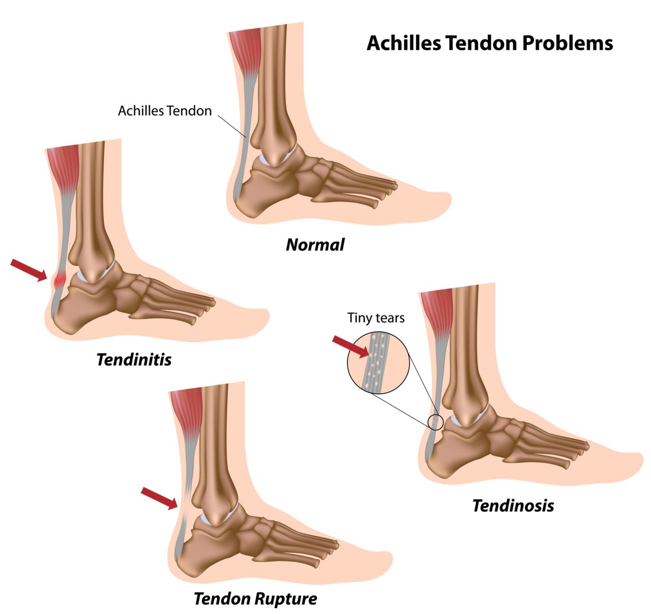 Achilles Tendon Injuries and Ruptures 
